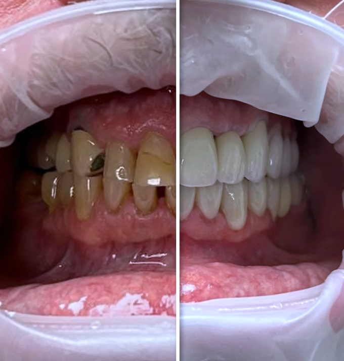 Porównanie uzębienia przed i po założeniu koron cyrkonowych