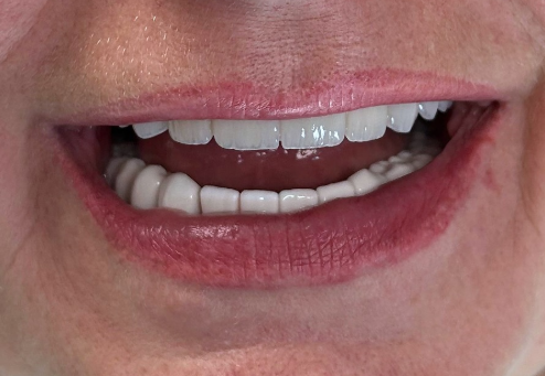 Uśmiech pacjenta po założeniu nowych koron protetycznych