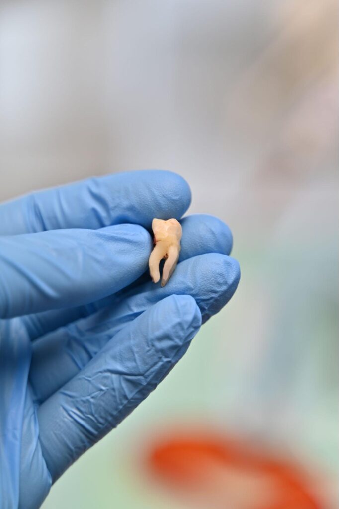 Usunięty ząb trzymany w rękawiczce medycznej