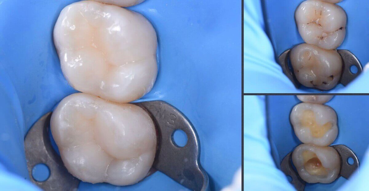 Trzy zdjęcia zębów trzonowych w niebieskim koferdamie: po prawej etap usunięcia próchnicy i przygotowania ubytku, po lewej gotowe wypełnienie kompozytowe z odtworzoną anatomią.