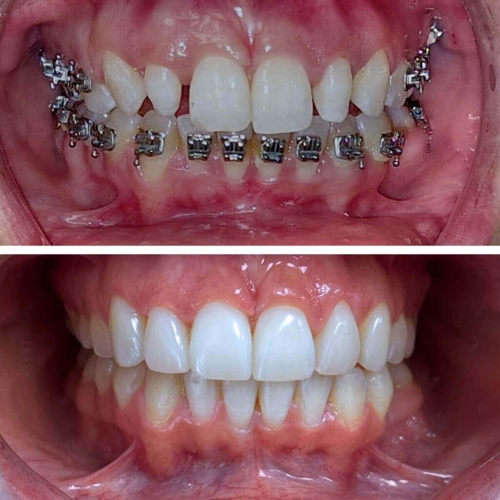 Zdjęcie porównawcze uśmiechu: górny kadr przedstawia zęby z aparatem ortodontycznym, dolny kadr pokazuje efekt końcowy po odbudowie estetycznej.