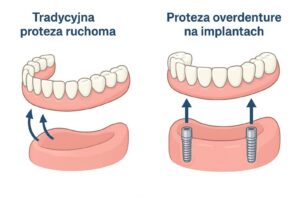 Infografika porównująca tradycyjną protezę ruchomą z protezą typu overdenture mocowaną na dwóch implantach zębowych.