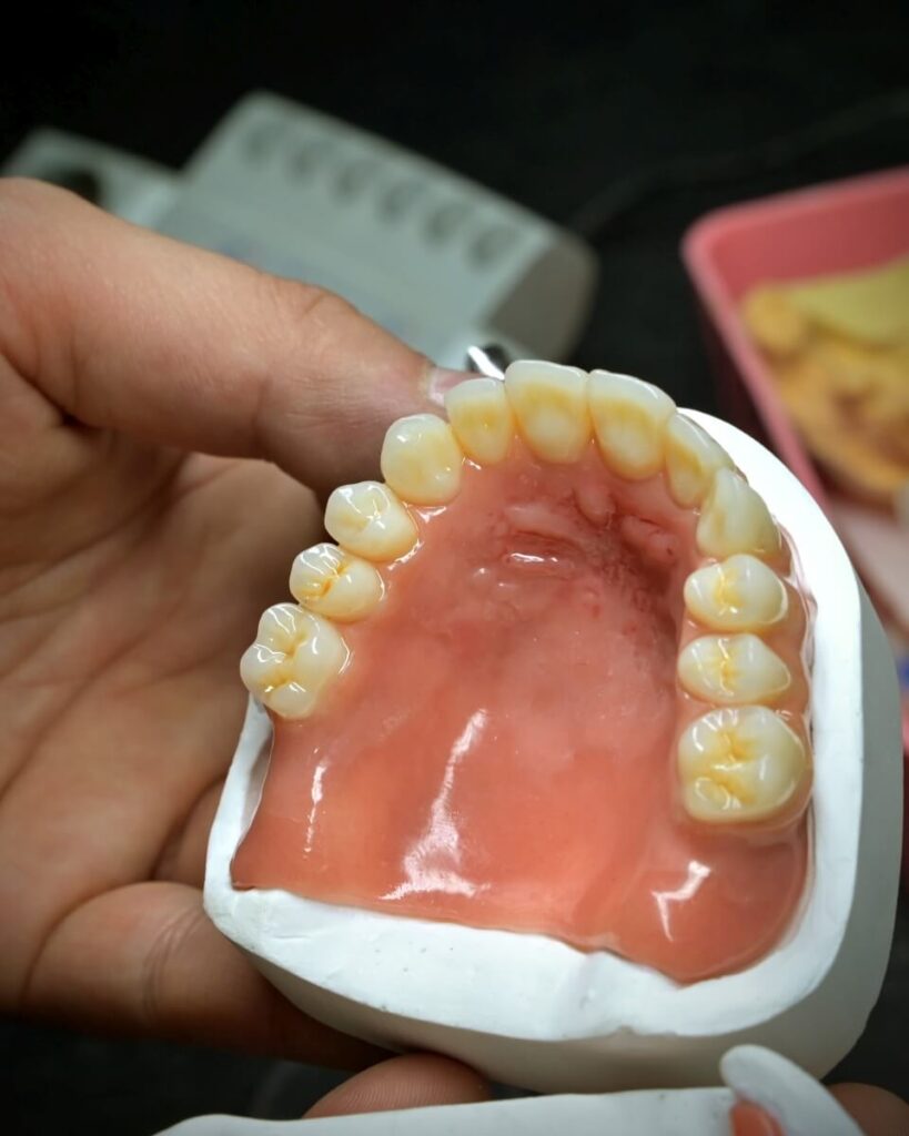 Proteza całkowita górna wykonana z różowego akrylu z osadzonymi zębami, zaprezentowana na gipsowym modelu szczęki trzymanym w dłoni.