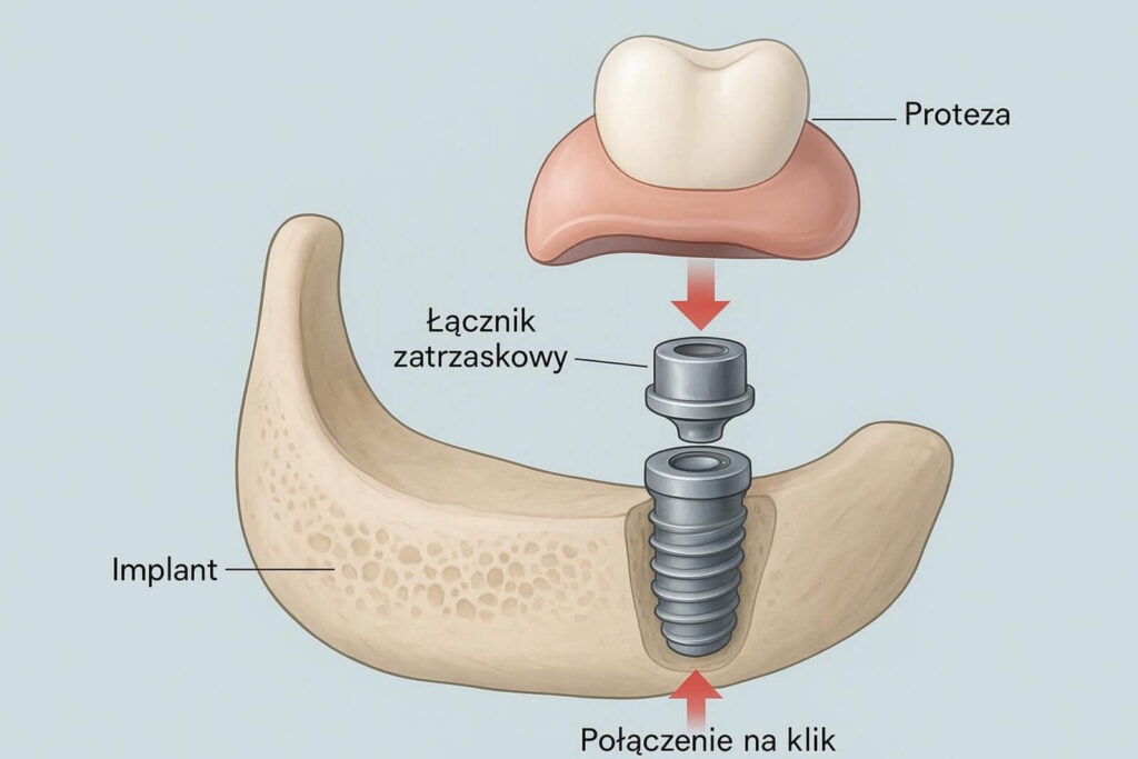 Schematyczny rysunek przekroju żuchwy z osadzonym implantem, łącznikiem zatrzaskowym oraz dopasowaną do niego protezą zębową.