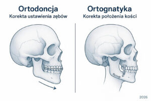 Schematyczny rysunek czaszki porównujący ortodoncję, czyli prostowanie zębów aparatem, z ortognatyką, polegającą na chirurgicznej korekcie położenia kości szczęki i żuchwy.