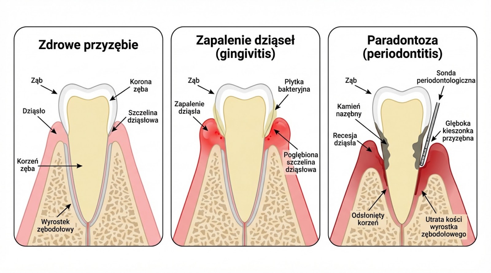 Infografika medyczna porównująca trzy stany przyzębia: zdrowe przyzębie, zapalenie dziąseł (gingivitis) z widoczną płytką bakteryjną oraz zaawansowaną paradontozę (periodontitis) z kamieniem nazębnym, recesją dziąseł i utratą kości.