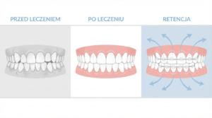 Ilustracja medyczna przedstawiająca trzy fazy: zęby przed leczeniem z wadą zgryzu, idealnie równe zęby po leczeniu oraz fazę retencji z zaznaczonymi strzałkami sił nacisku, które są blokowane przez aparat retencyjny.