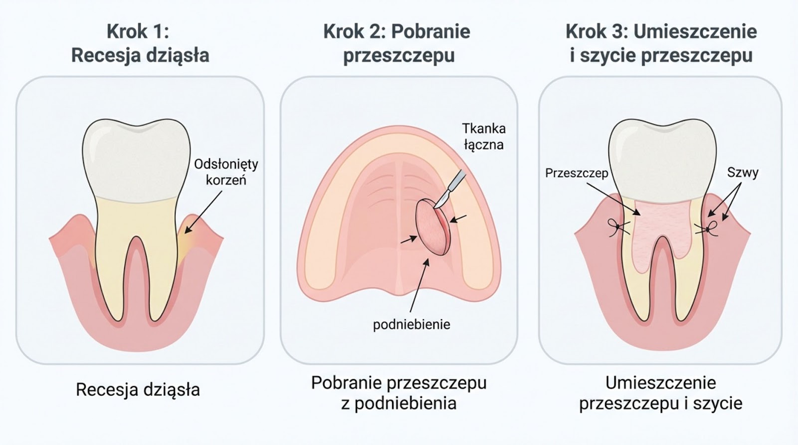 Trzystopniowy schemat zabiegu pokrycia recesji dziąsła: od odsłoniętego korzenia, przez pobranie tkanki łącznej z podniebienia, po umieszczenie przeszczepu i założenie szwów na zębie.