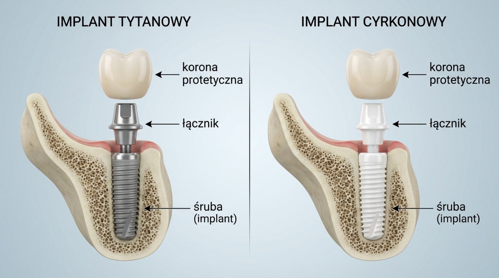 Porównanie implantu tytanowego i cyrkonowego z oznaczeniami części: korona protetyczna, łącznik, śruba (implant)