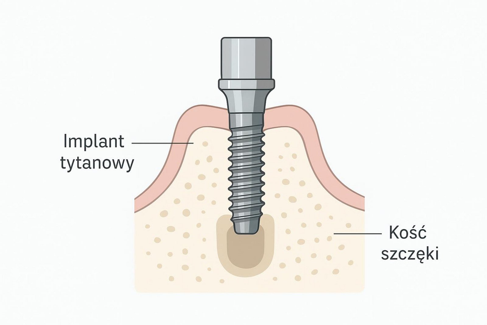 Ilustracja implantu tytanowego w kości szczęki, z oznaczeniem implant i kość szczęki