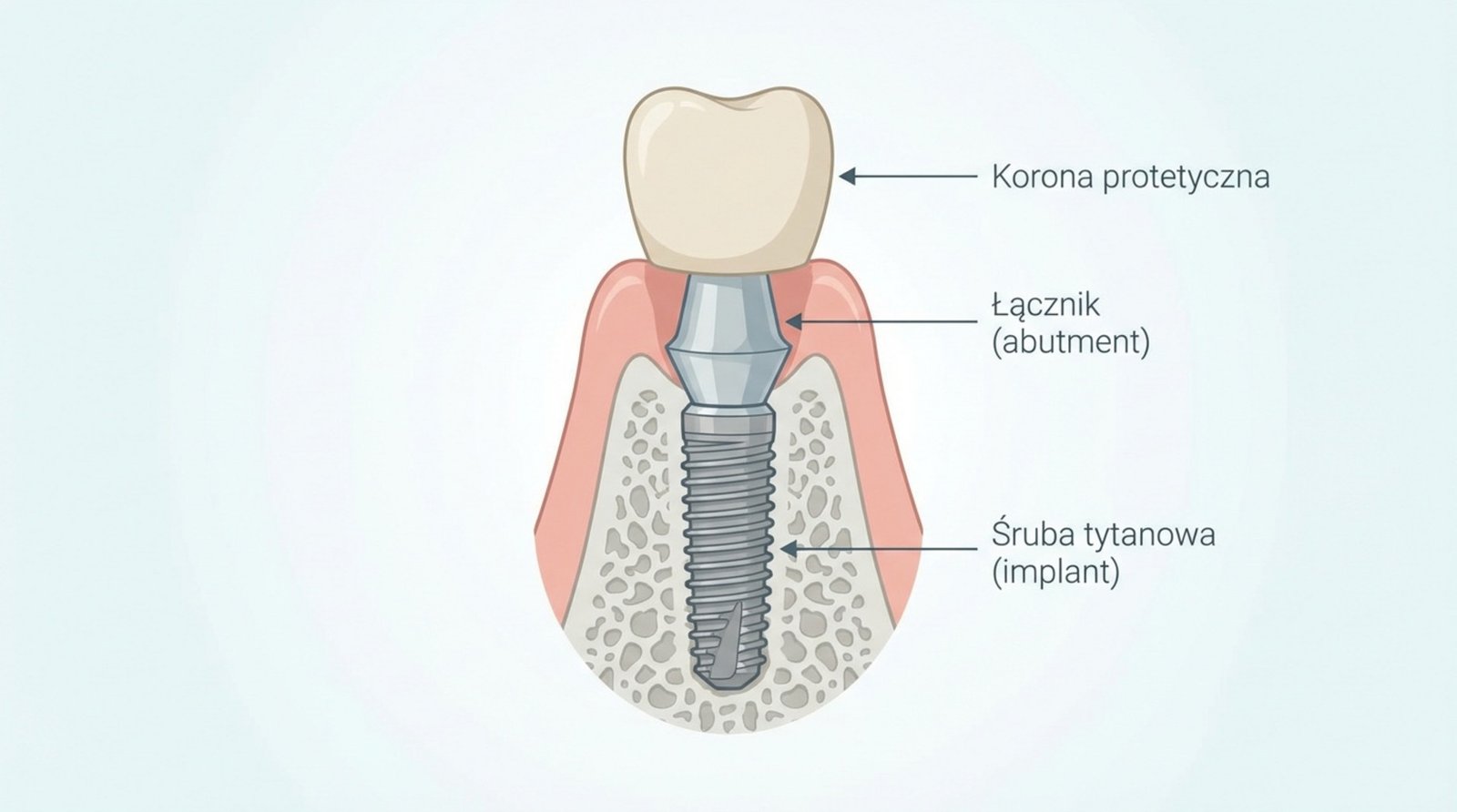 Schemat implantu tytanowego z oznaczeniami: korona protetyczna, łącznik (abutment), śruba tytanowa (implant)