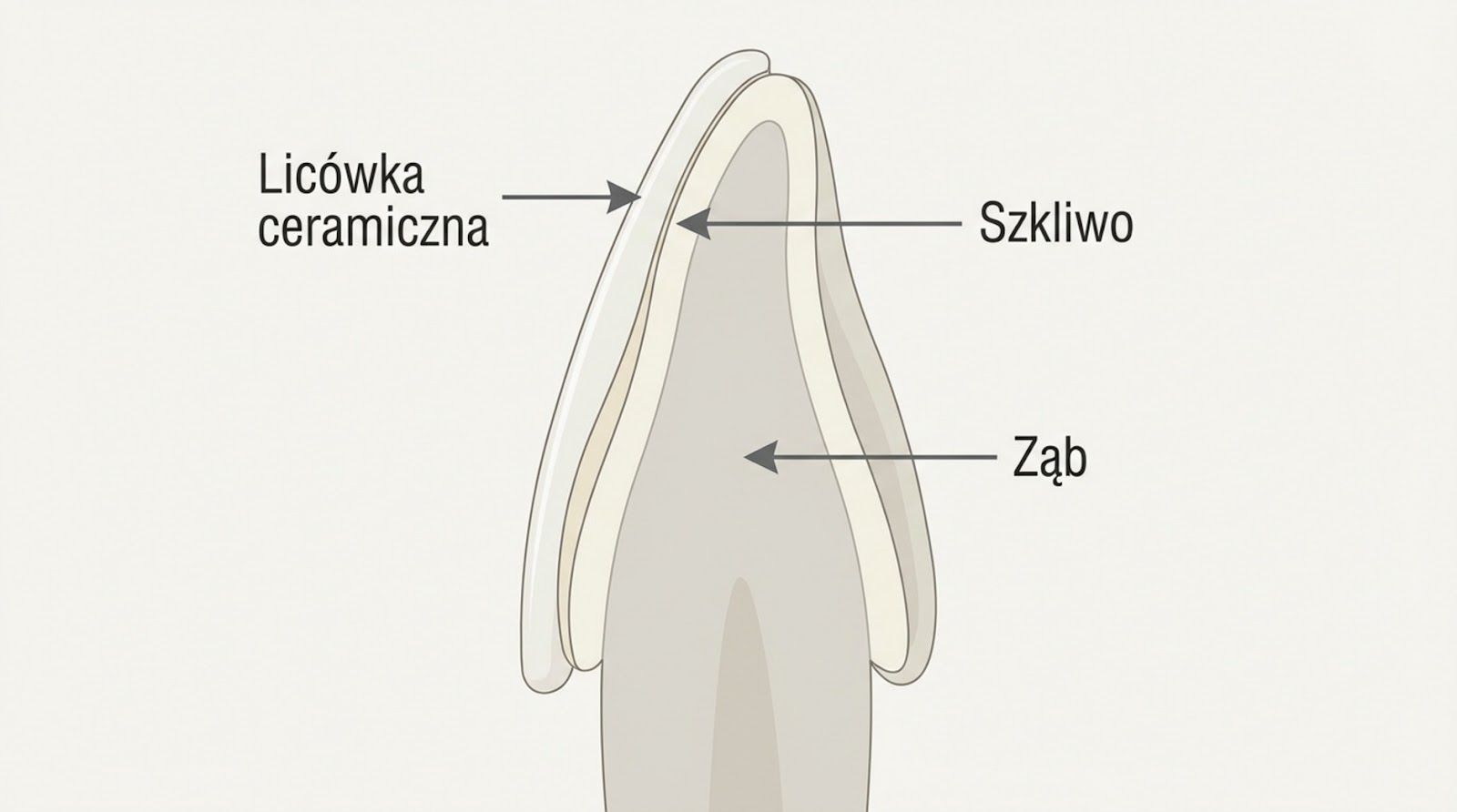 Przekrój poprzeczny zęba z nałożoną licówką ceramiczną. Strzałki wskazują poszczególne warstwy: licówkę ceramiczną, szkliwo oraz strukturę zęba.