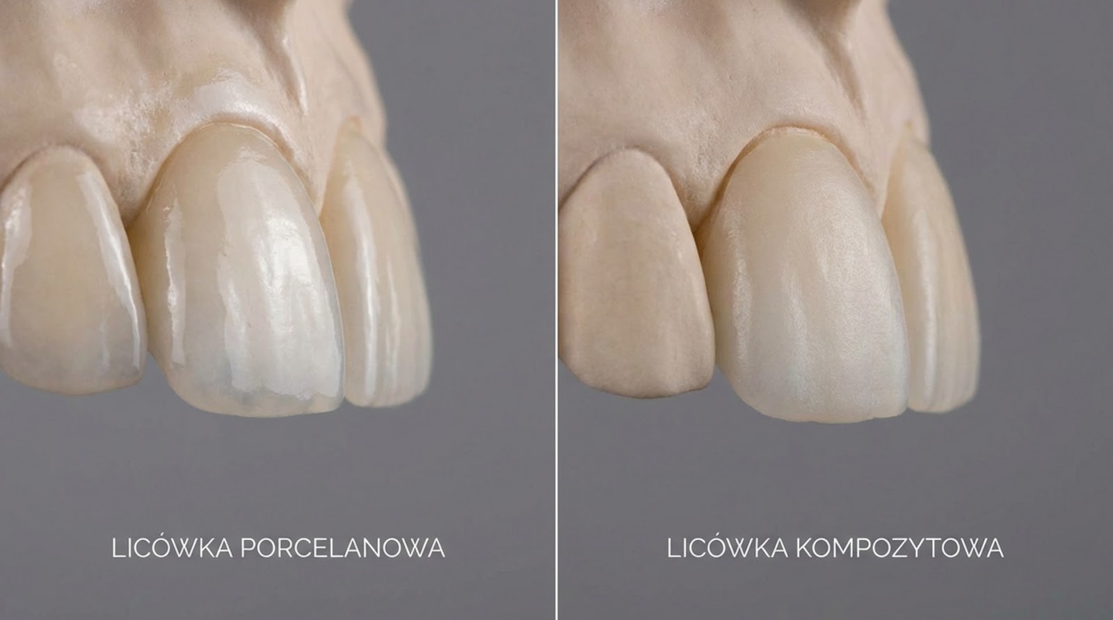 Zdjęcie porównawcze dwóch rodzajów licówek na modelu uzębienia. Po lewej licówka porcelanowa o wysokim połysku i przezierności, po prawej licówka kompozytowa o bardziej matowym wykończeniu.