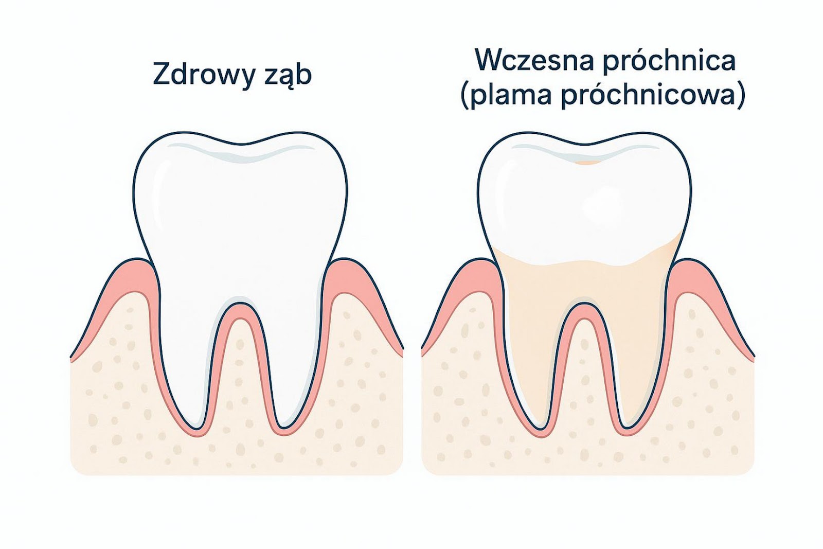 Ilustracja porównująca zdrowy ząb i wczesną próchnicę (plama próchnicowa)