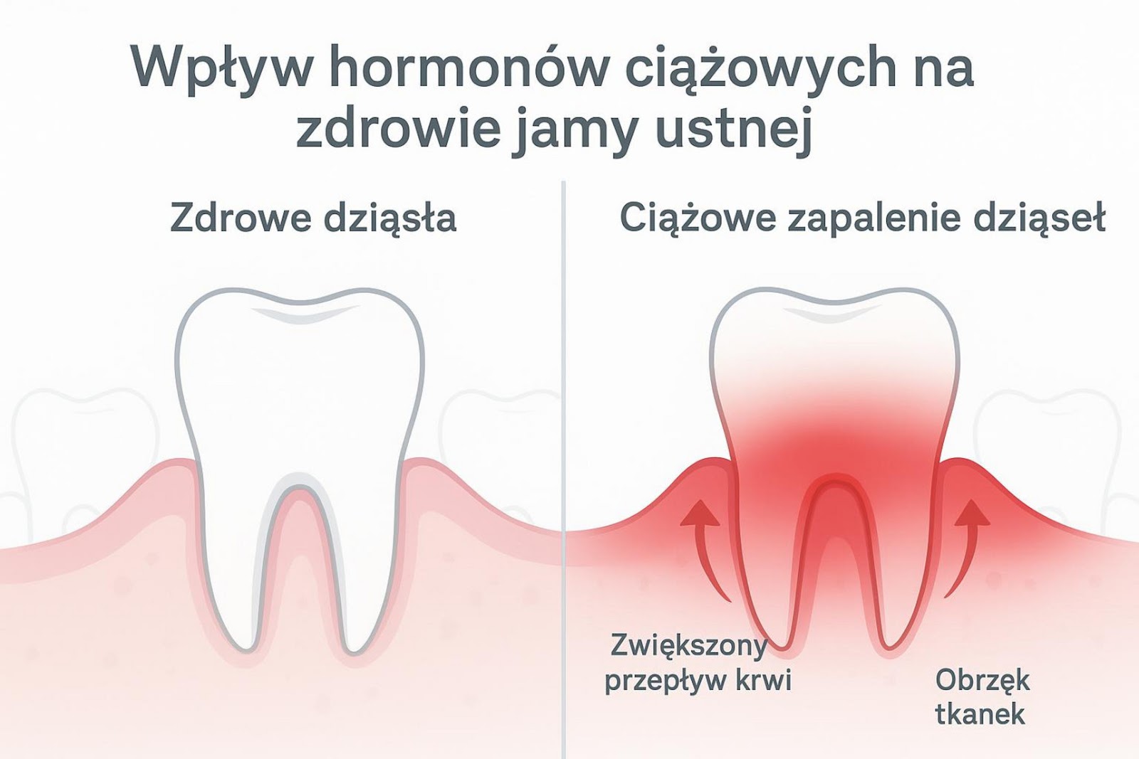Ilustracja przedstawiająca wpływ hormonów ciążowych na zdrowie jamy ustnej, z oznaczeniem zdrowych dziąseł i ciążowego zapalenia dziąseł