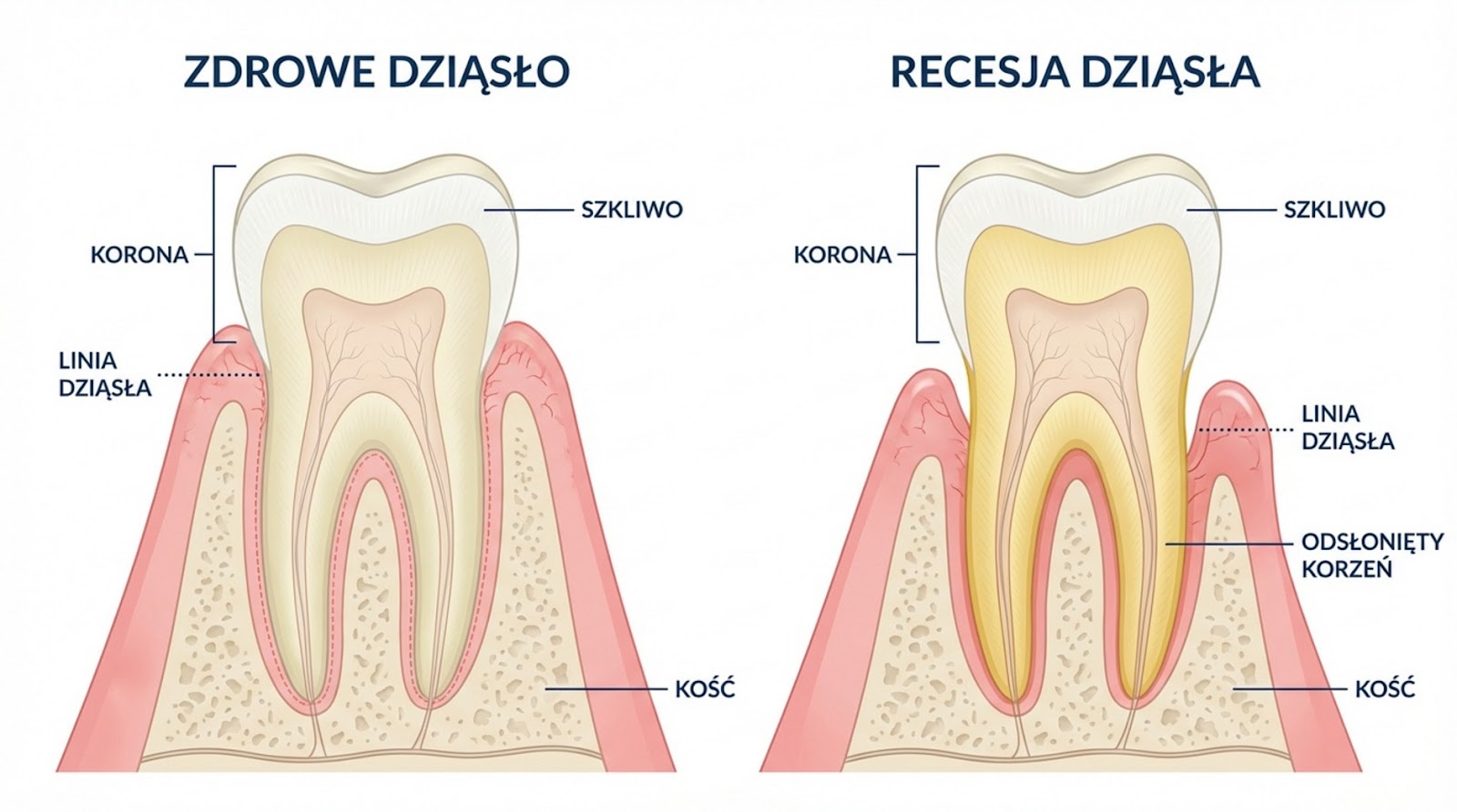 Ilustracja porównawcza zdrowego zęba z prawidłową linią dziąseł oraz zęba z recesją dziąsła, na której widoczny jest odsłonięty korzeń.