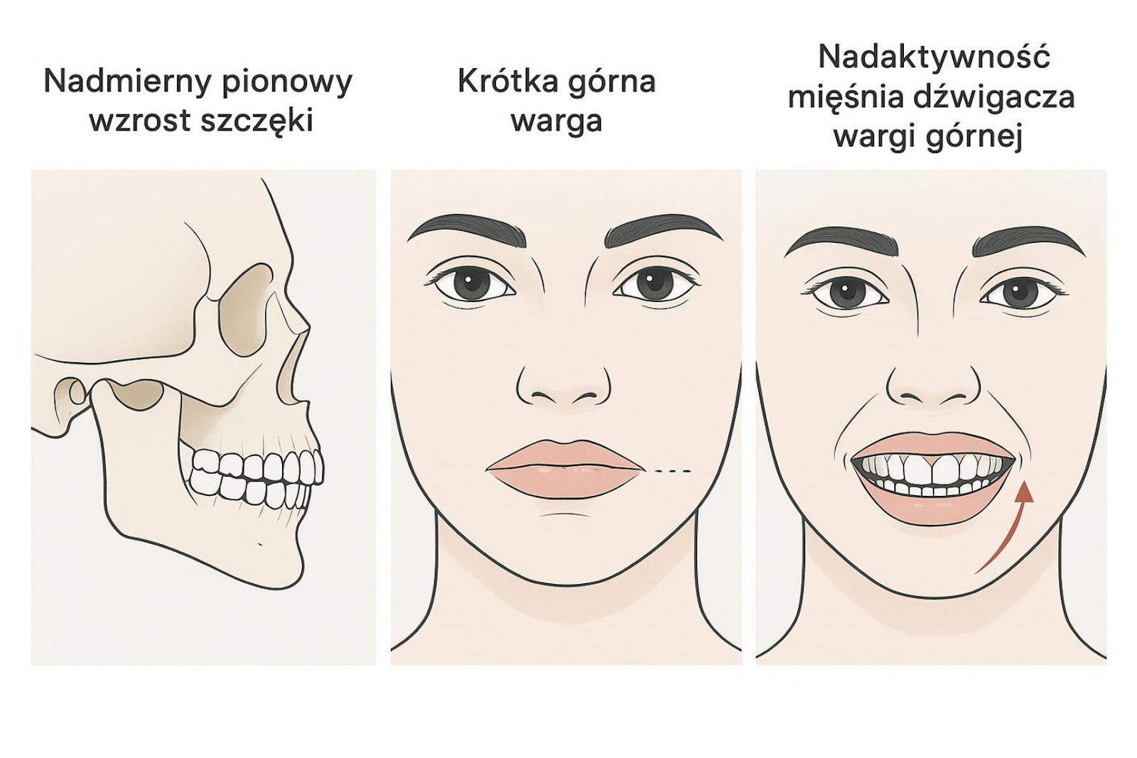 Ilustracja przedstawiająca przyczyny "gummy smile": nadmierny pionowy wzrost szczęki, krótką górną wargę i nadaktywność mięśnia dźwigacza wargi górnej