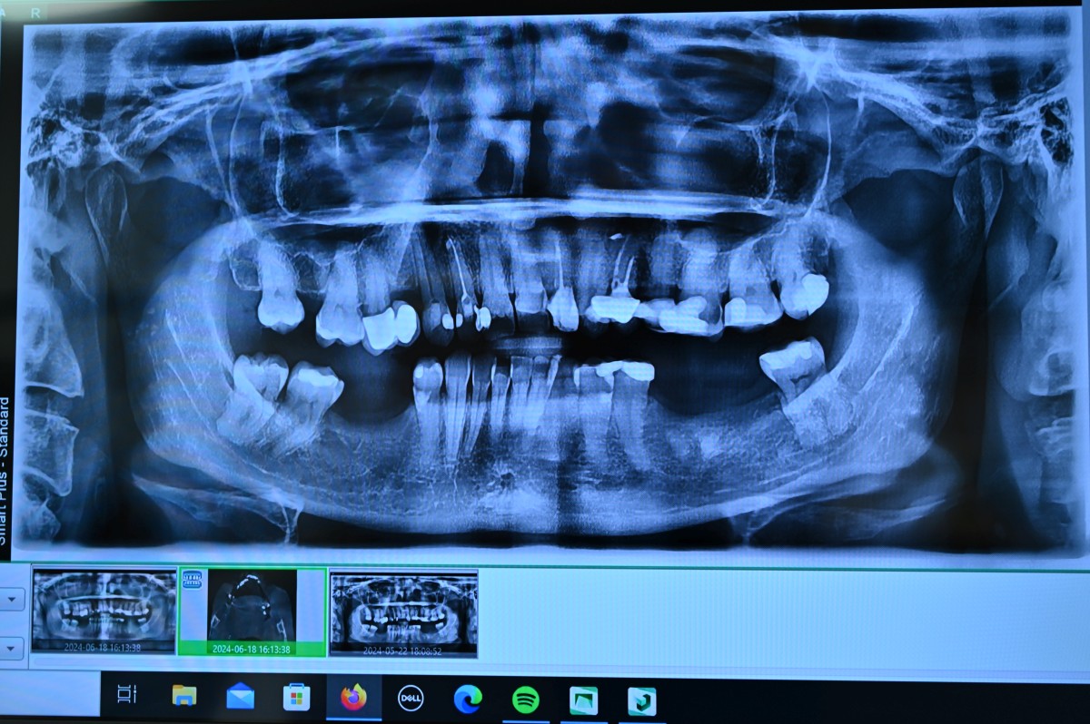 Panoramiczne zdjęcie rentgenowskie uzębienia (pantomogram) wyświetlone na ekranie monitora, pokazujące stan zębów, korzeni oraz kości szczęki i żuchwy.